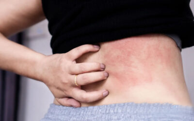 Orticaria patologie frequente in chi soffre di asma bronchiale