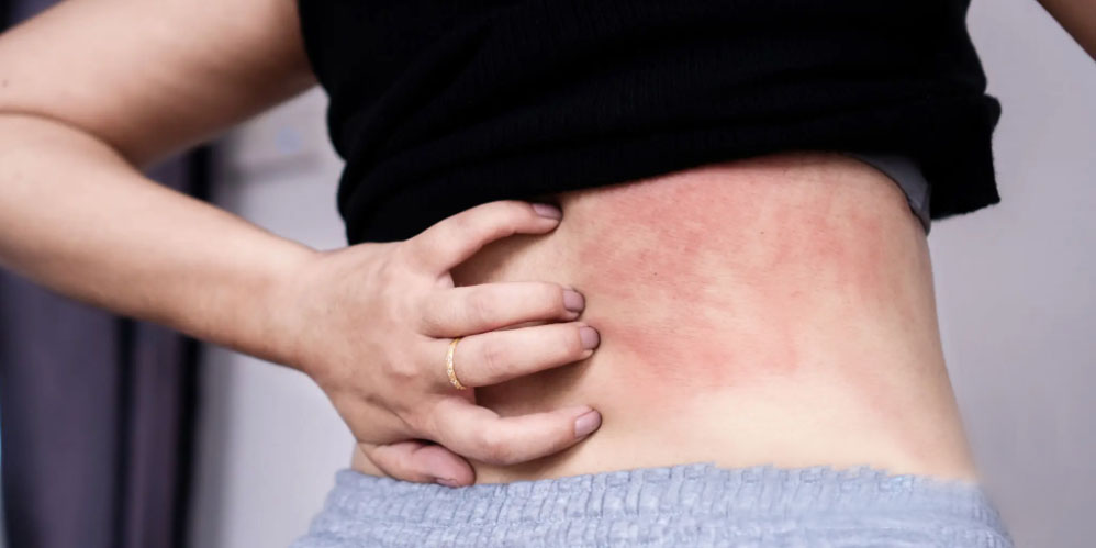Orticaria patologie frequente in chi soffre di asma bronchiale