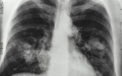 Metastasi polmonari da colangiocarcinoma