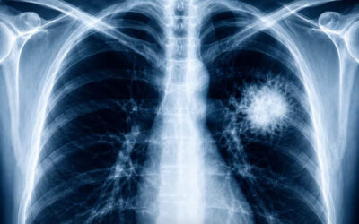 Nuove evidenze tra svapare e cancro al polmone
